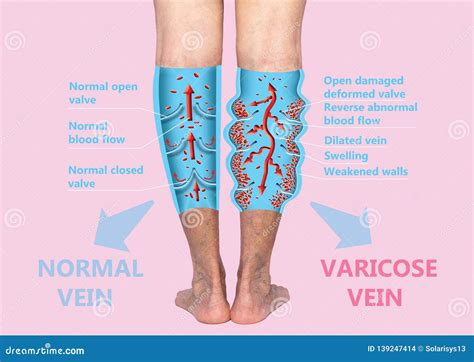 Varicose Veins On A Female Senior Legs The Structure Of Normal And