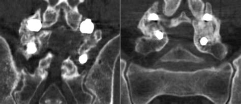 Potential Significance Of Facet Joint Fusion Or Posteromedial Fusion