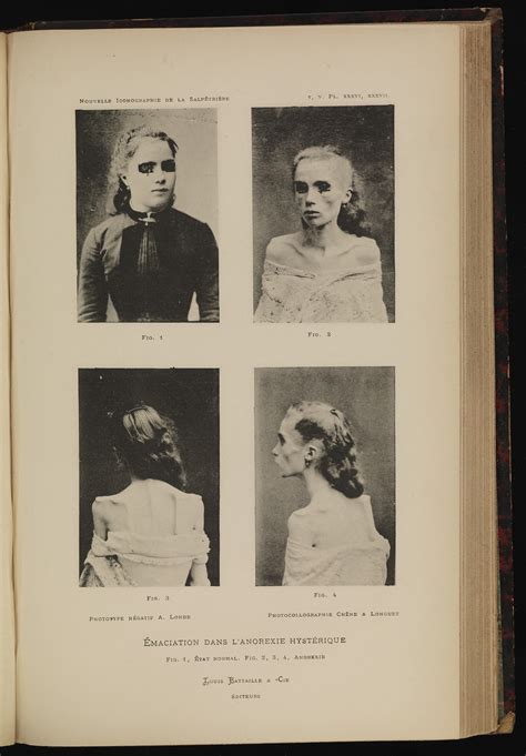 Filefour Photographs Of A Woman Showing Anorexia Nervosa Wellcome