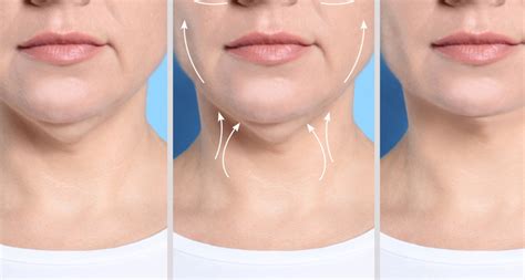 Double Chin Liposuction Surgery Procedure And Recovery