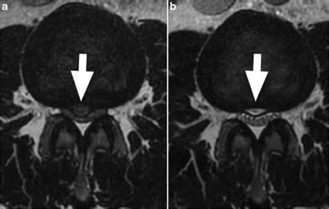 A Axial T2 Before Apld Median L3l4 Hernia Arrowhead With Compression