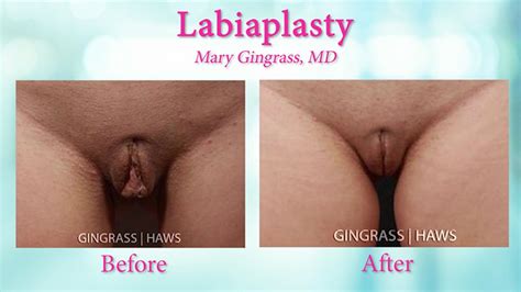 Pretty Up Your Privates With Labiaplasty The Plastic Surgery Channel