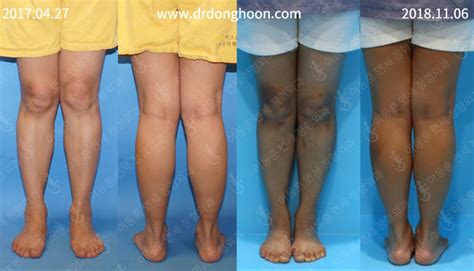Knock Knee Deformity After Leg Deformity Correction Surgery At Another