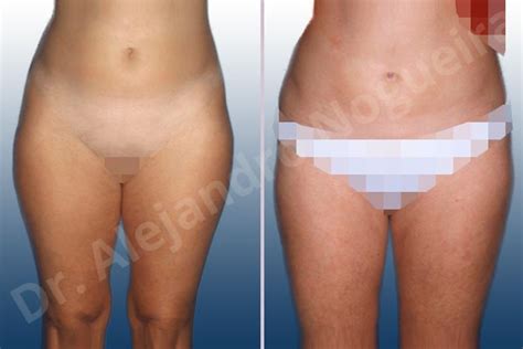 Abdomen Liposuction Thigh Liposuction