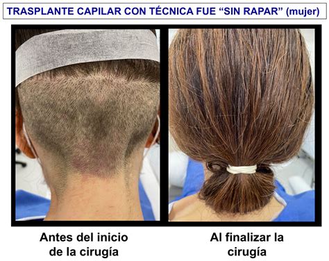 Trasplante Capilar Madrid Implante Injerto Precio Médico
