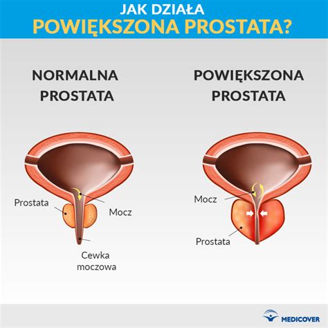 Reviews common tests for these conditions, as well as treatment side effects. Prostata | Leczenie chorób prostaty
