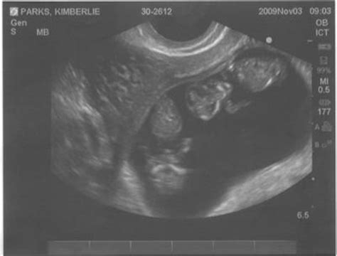 Hospitals in england will usually offer you two ultrasound scans during your pregnancy. Wow! - 11 Week Twin Ultrasound