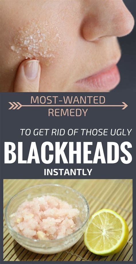 You Can Get Rid Of Blackheads With A Simple And Effective Mask That Can
