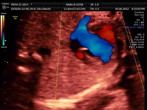 Hypoplastic Left Heart Syndrome Hlhs Looking Through A Transducer