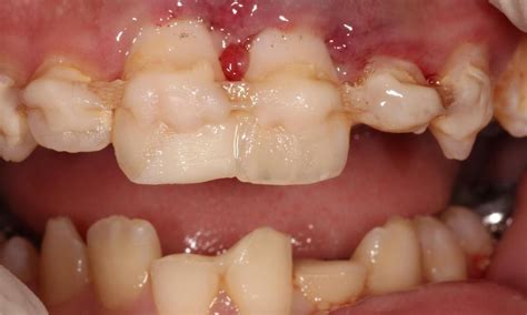 Gum Restoration Smile Gallery Before And After 16148 Pa