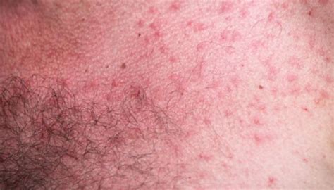 Heat Rash On Chest Broken Capillaries Rosacea Treatment Rosacea