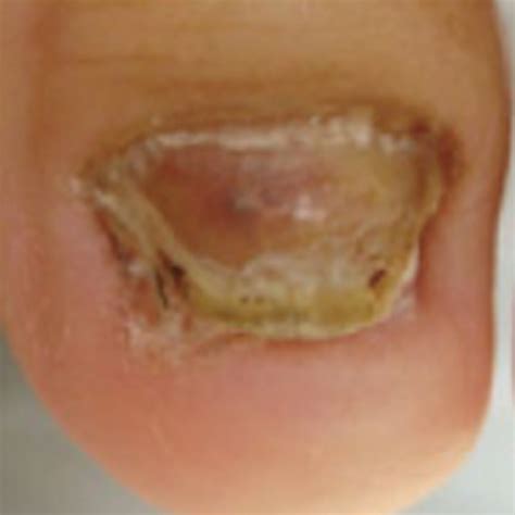 変形爪投稿 - 神戸の巻き爪治療専門店｜神戸足の治療院