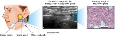 Ab1215 Minimal Invasive Ultrasound Guided Parotid Gland Biopsy In