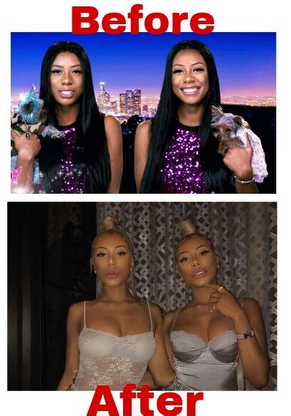 Clermont Twins Before And After Surgery Marcus Reid