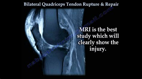 Bilateral Quadriceps Tendon Rupture And Repair Everything You Need To
