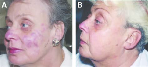 Long Standing Lupus Pernio Lesions In The Face After Pulsed Dye Laser