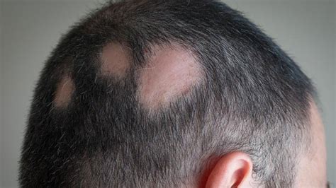 Alopecia Come Riconoscere Le Varie Tipologie Insalaco Clinic Porn Sex