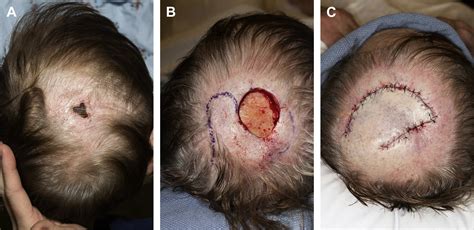 Scalp And Forehead Defects In The Post Mohs Surgery Patient Facial