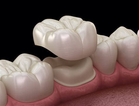 Restorative Dentist Dental Crowns In Colorado Springs Co Pinnacle