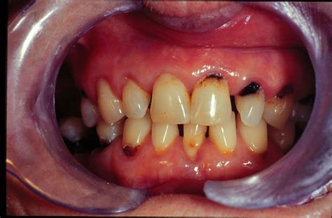 Caries Trastornos Odontológicos Manual Msd Versión Para Profesionales