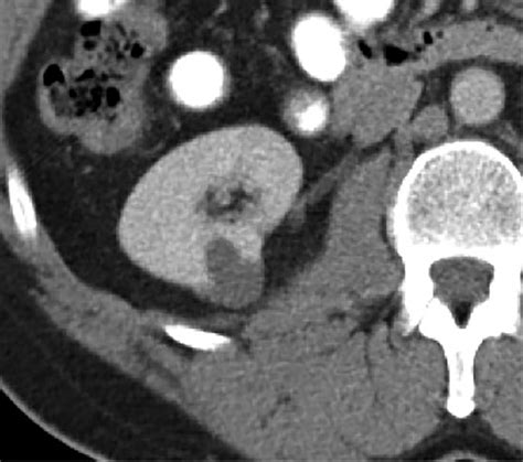 Differentiating Renal Neoplasms From Simple Cysts On Contrast Enhanced