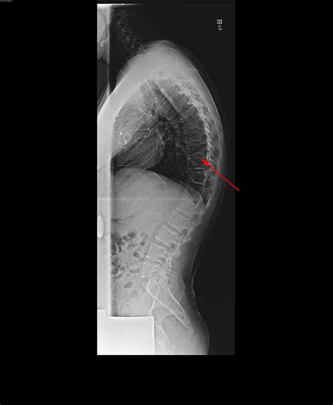 A Case Of Scheuermanns Disease Co Occurrence With Idiopathic Scoliosis