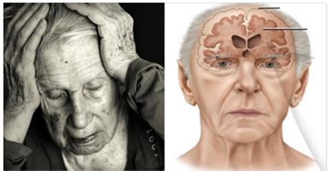 Alzheimer da sinais estes são os primeiros sintomas do mal de