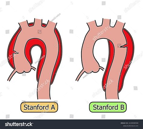 Aortic Dissection Stanford Classificationmedical Related Illustration