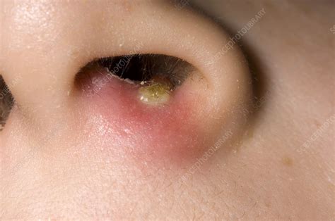 Nasal Abscess Stock Image M Science Photo Library