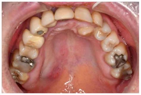 Swollen Salivary Glands Roof Of Mouth