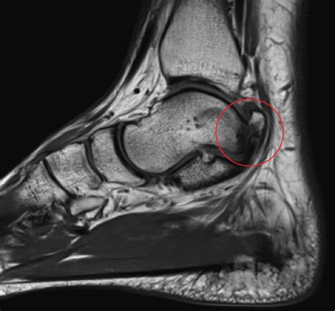 Sagittal Slice Of T2 Mri Of Right Ankle Showing The Posteromedial Talus