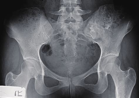 X Ray Of The Pelvis Ap View Shows Ill Defined Mixed Lytic And