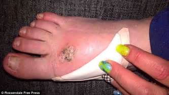 Lancashire Mum Left With Zombie Foot After Spider Bite Daily Mail
