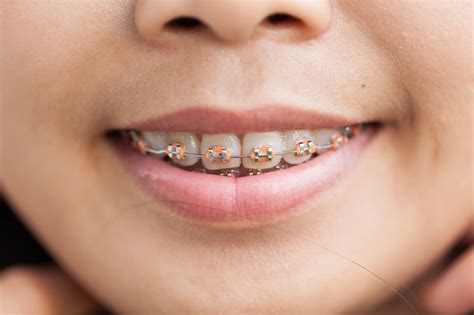 Premium Photo Closeup Ceramic And Metal Braces On Teeth
