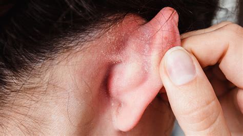 Why You Get Dry Skin Behind Your Ears And How To Treat It