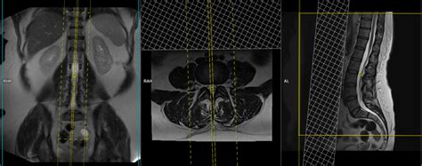 Lumbar Lumbosacral Spine Mri Planning And Protocols Indications For