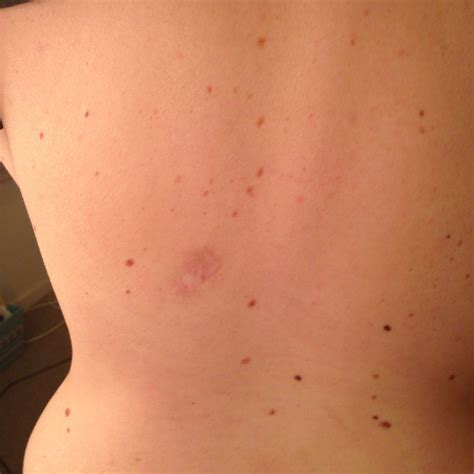 What Does Skin Cancer Look Like On Your Back