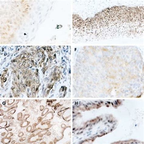 Scoring System For P16 Ink4a Immunostaining In Cin3 Lesions A