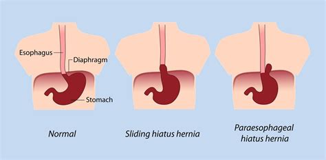 Hernia Symptoms Abdomen Hiatal Hernia Types Of Hernia Treatment Hernia Surgery In Perth