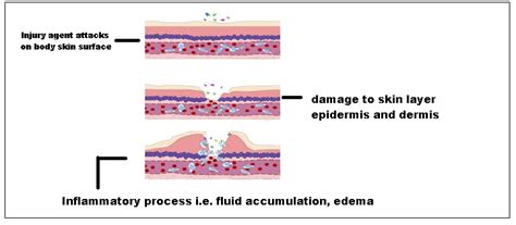 Inflammation Process Sign Treatment