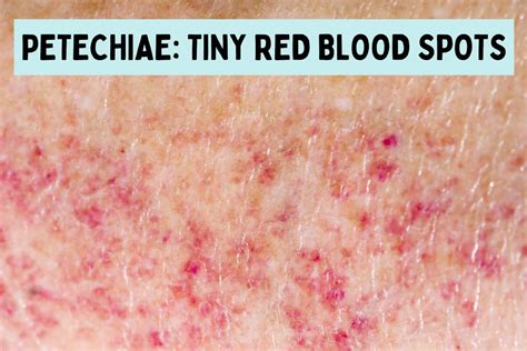 Petechiae What Causes These Tiny Red Blood Spots On Skin
