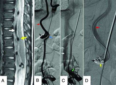Spinal Vascular Shunts A Patterned Approach American Journal Of