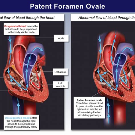 Patent Foramen Ovale Trialexhibits Inc