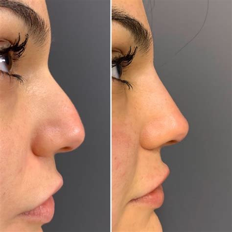 How Much Is A Non Surgical Nose Job Toronto Khalilah Coffey