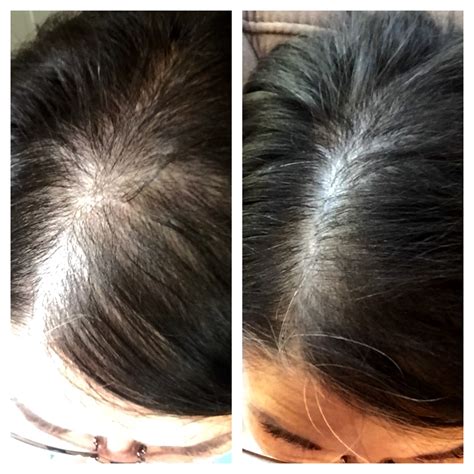 However, this has caused major hair growth on my face especially on my cheeks. Women's Rogaine Does it really Work? YES it does! - Pink ...