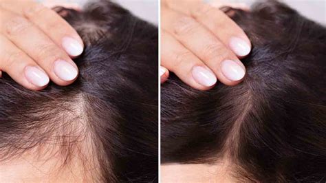 Hair Fall Solution At Home महिलाओं में बाल झड़ने के उपाय Lambe Baal