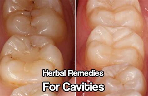 When this area is exposed, your teeth can become especially sensitive to hot, cold how to treat cavity pain. Herbal Remedies For Cavities | SHTFPreparedness