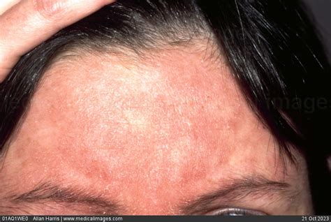 Stock Image Dermatology Seborrheic Dermatitis Inflamed Red And Flaky