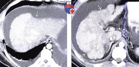 КТ, МРТ, УЗИ при вирусном гепатите Картинка - КТ, МРТ, УЗИ при вирусном гепатите