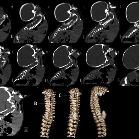 A Sagittal Reformatted Mpr Ct Image Of The Cervicothoracolumbar Spine